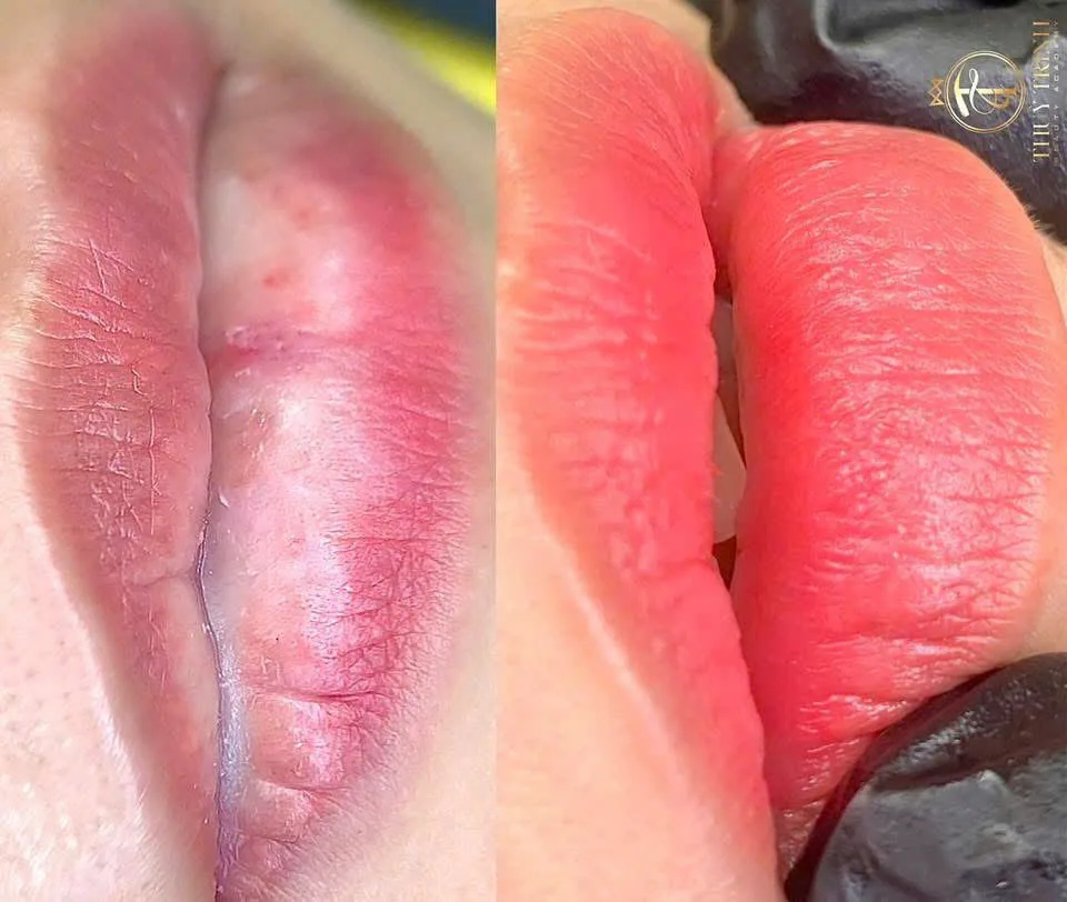 So sánh Trước & Sau khử thâm môi bẩm sinh, sắc môi trong trẻo mềm mịn