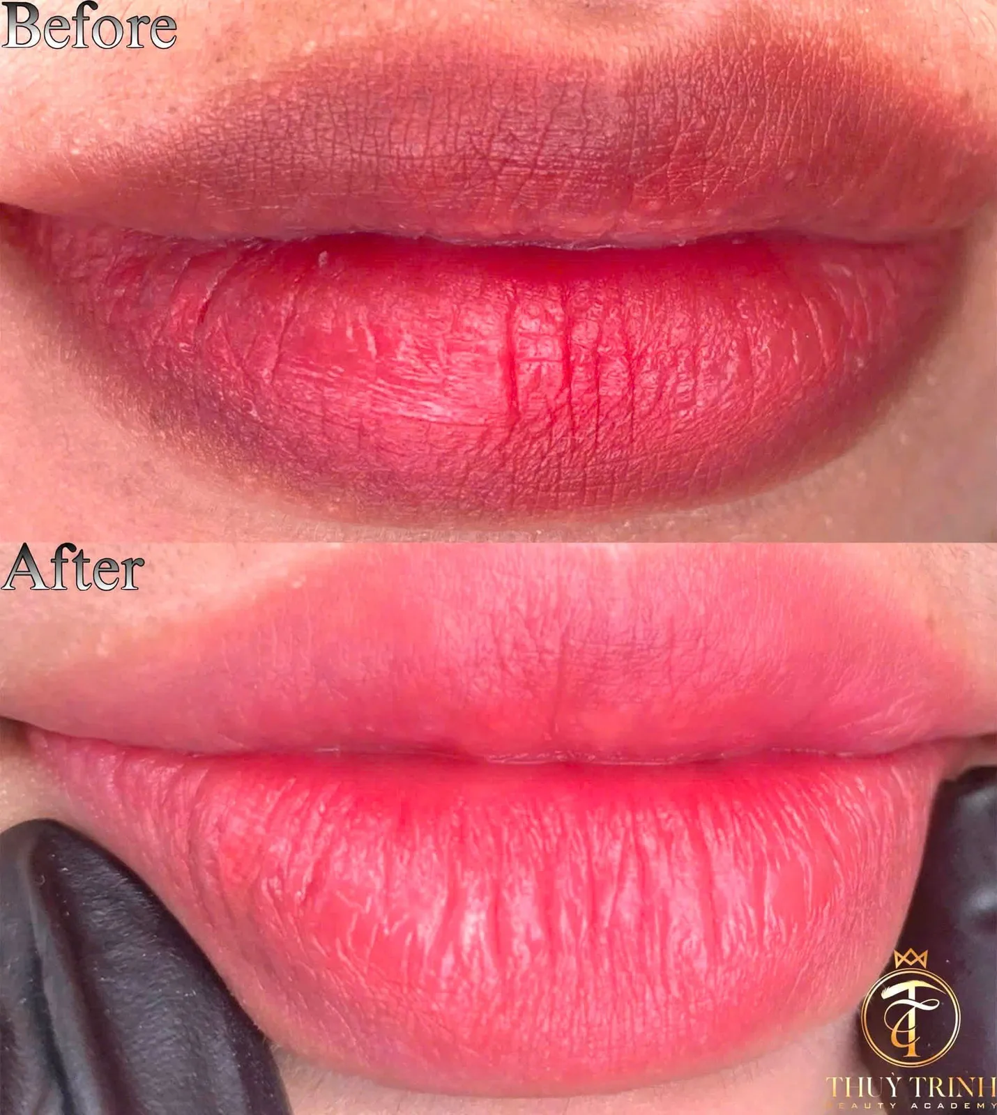 Before & After khử thâm môi chuyên sâu, phục hồi bờ môi hồng hào tràn sức sống