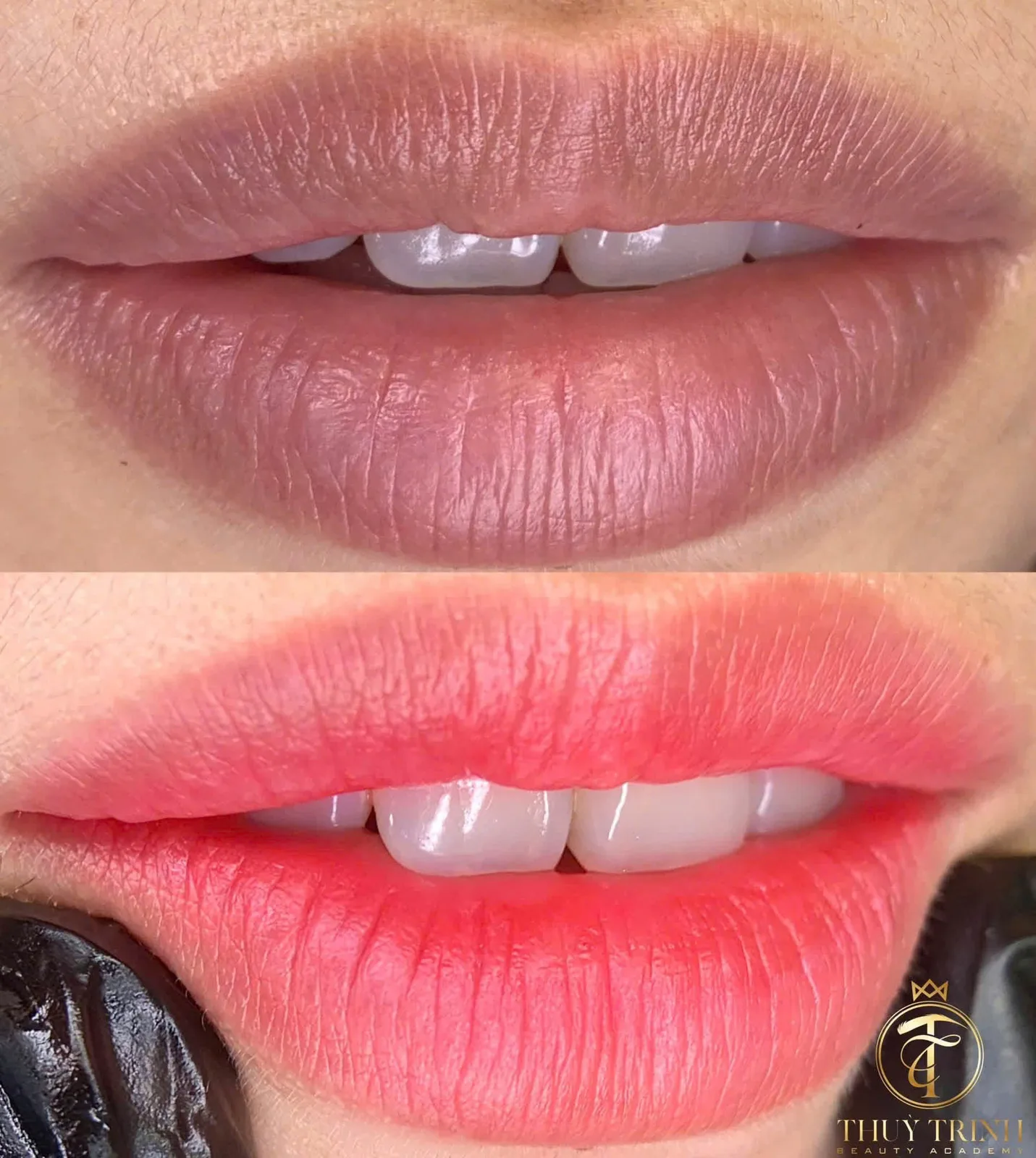 Trước & Sau khử thâm môi lâu năm, bề mặt môi mịn màng giảm hẳn rãnh nhăn