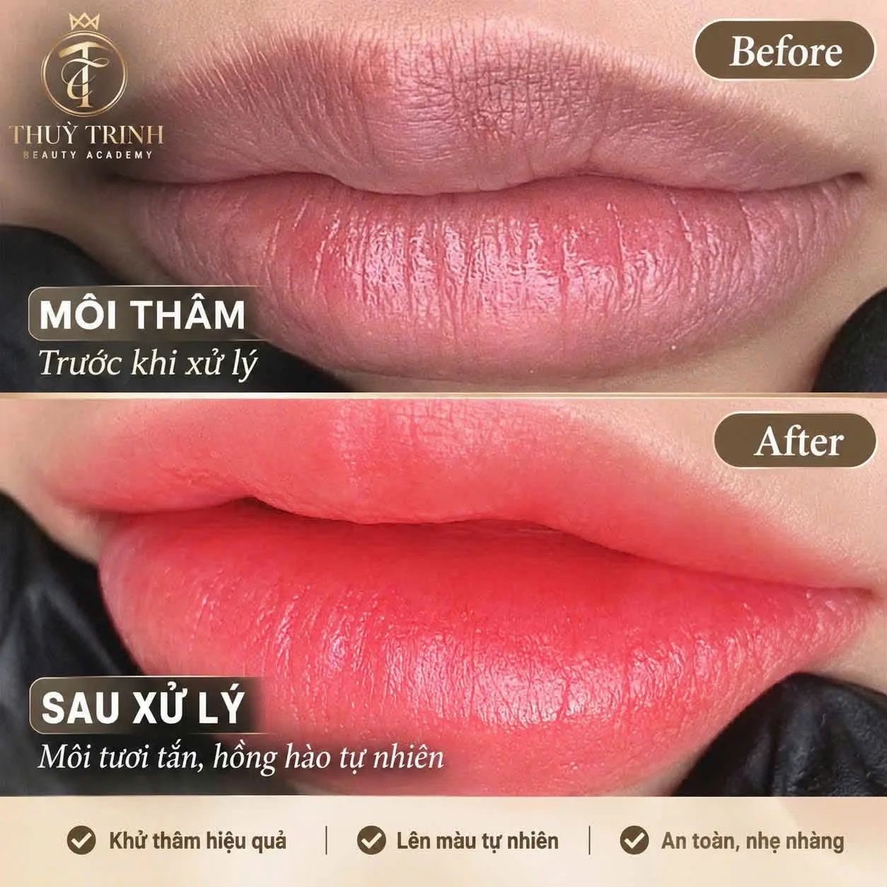 Môi thâm trước khi xử lý & Sau xử lý: Lên màu tươi tắn, hồng hào tự nhiên