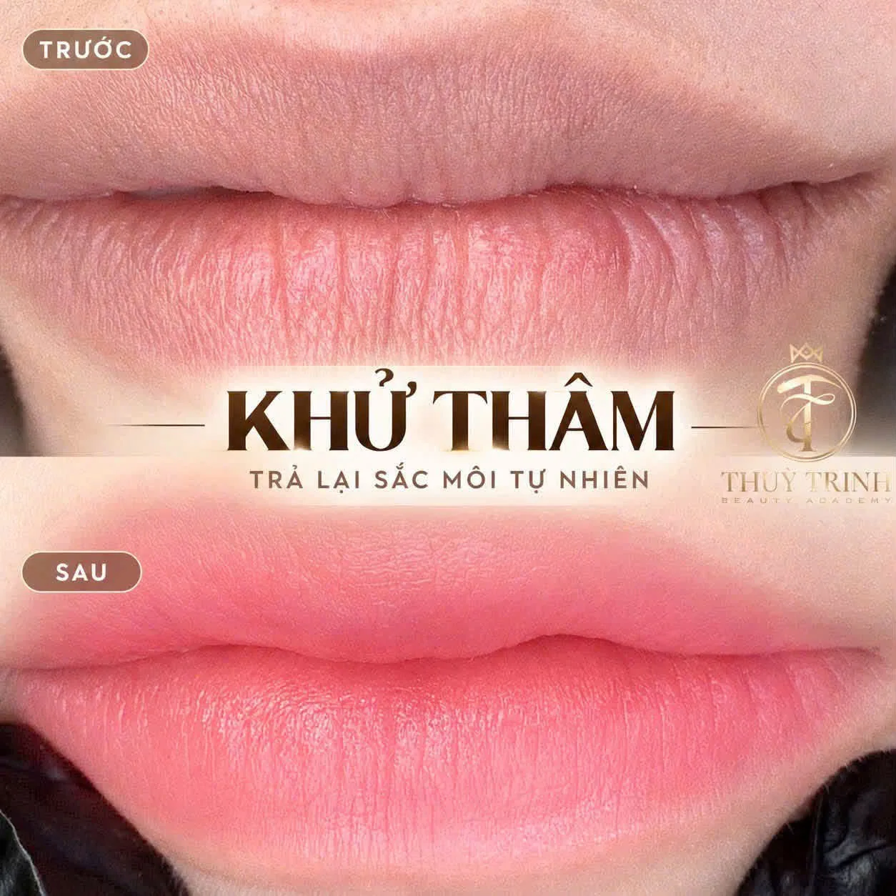 Khử thâm trả lại sắc môi tự nhiên – Kết quả sau xử lý nền môi thâm viền đậm