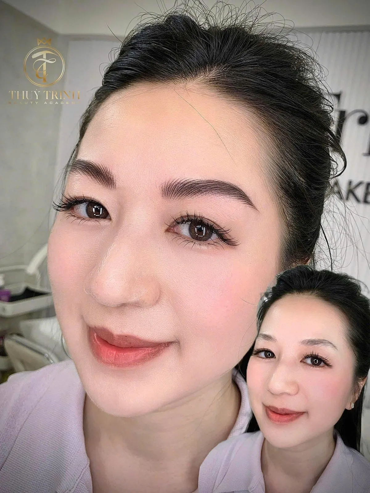 Hình ảnh Before & After toàn gương mặt khách hàng sau khi làm mày & môi tại viện
