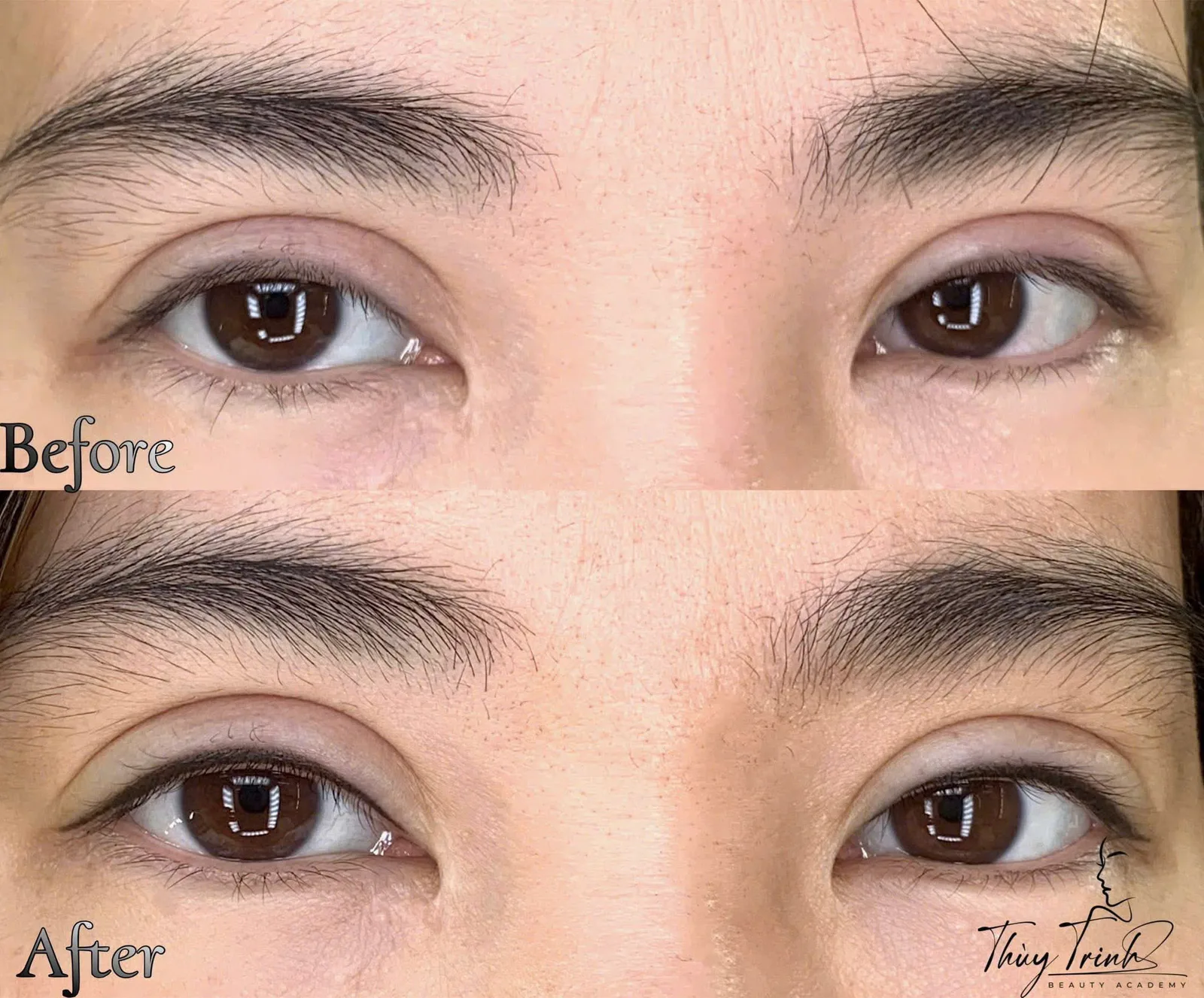 Toàn cảnh đôi mắt Before & After phun mí mở tròng – Đôi mắt long lanh, sắc nét