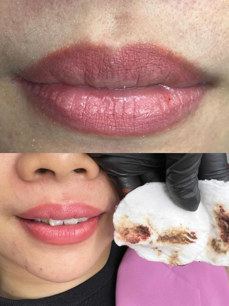 Hạt mực thâm bết được hút trực tiếp ra miếng bông gòn y tế