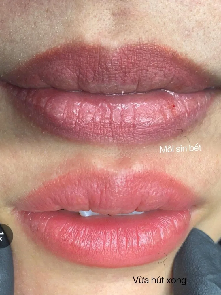Môi xỉn bết trở nên hồng hào ngay khi vừa hút dung dịch xong