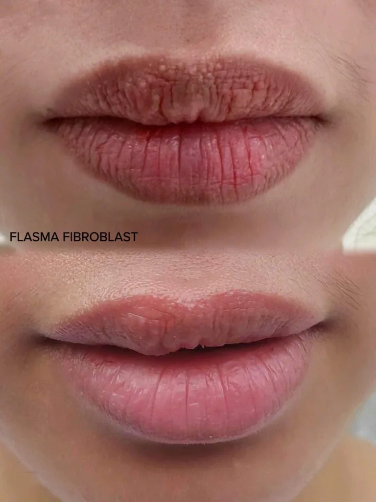 Plasma Fibroblast xử lý hạt Fordyce cả hai môi trên và dưới