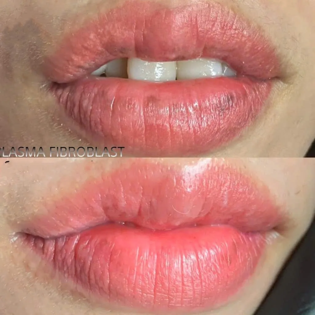 Xử lý nền môi cũ bết màu bằng Plasma Fibroblast tại Master Thuỳ Trinh