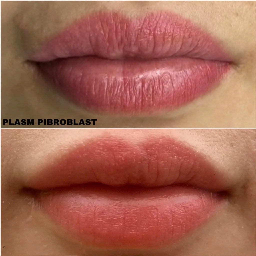 Cân bằng môi không đều màu trước và sau chấm Plasma