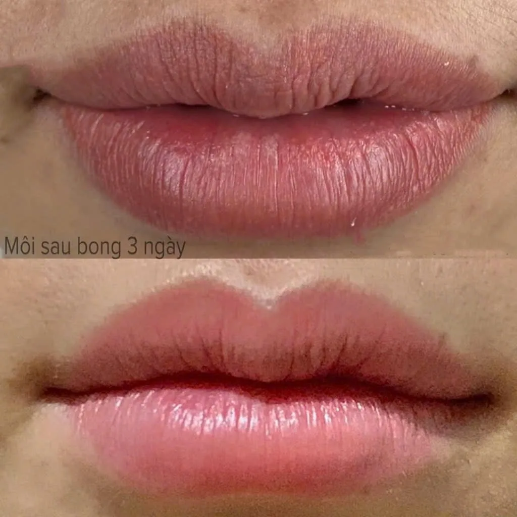 Môi sau bong 3 ngày phục hồi căng mọng tự nhiên