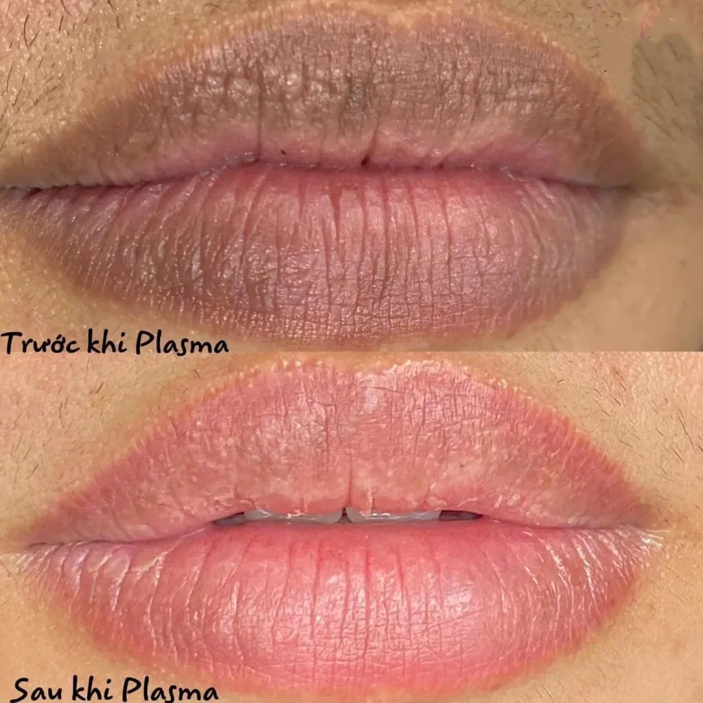 Môi thâm đen trước và sau khi xử lý Plasma tại Master Thuỳ Trinh
