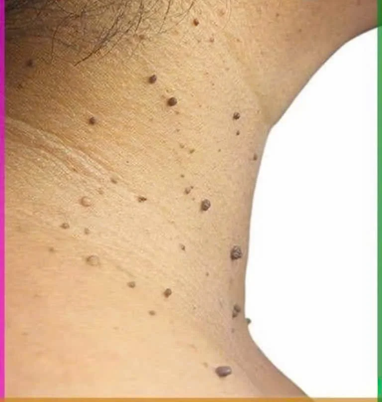 Mụn thịt vùng cổ diện rộng dày đặc