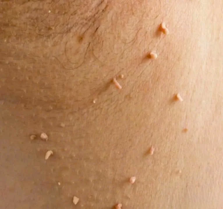 Cụm mụn thịt nhỏ li ti quanh mắt